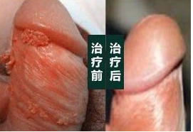 HPV病毒怎么治疗